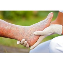 Żylaki, czyli poszerzone naczynia żylne występujące najczęściej na nogach, którym mogą towarzyszyć stany zapalne i zakrzepica oraz przebarwienia skóry, są problemem co czwartego Polaka
