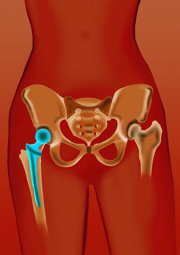 W przypadku złamania kości udowej w stawie biodrowym, na ogół wszczepia się endoprotezę stawu biodrowego.     