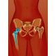 W przypadku złamania kości udowej w stawie biodrowym, na ogół wszczepia się endoprotezę stawu biodrowego.     