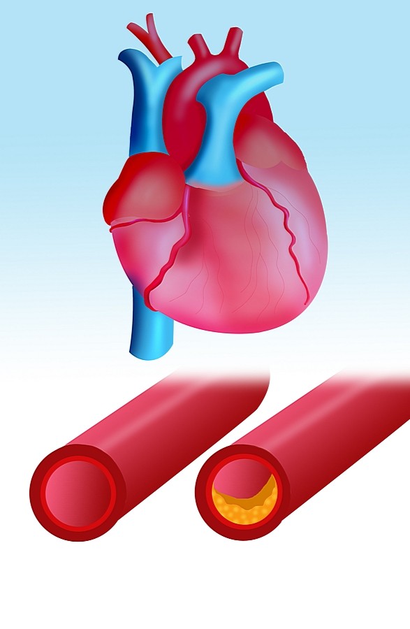 Zwężenie nawet jednej, stosunkowo drobnej tętnicy, może doprowadzić do ogólnoustrojowej katastrofy. Stąd choroba wieńcowa stanowi duże zagrożenia dla życia 