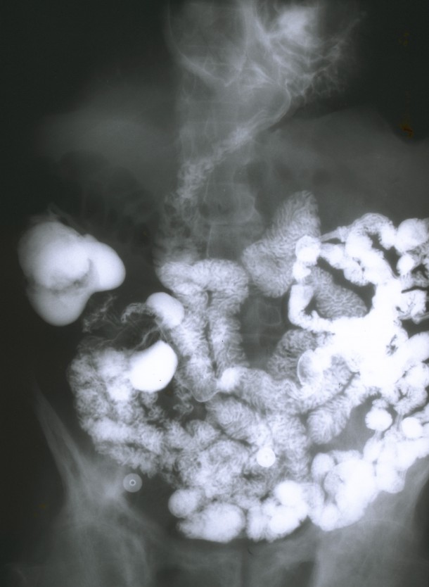 Uchyłki najlepiej uwidacznia rentgen jelita grubego po podaniu kontrastu. Ale uchyłkowatość jelita grubego można też stwierdzić w kolonoskopii.    