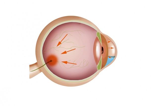 Istotą jaskry jest wzrost ciśnienia śródgałkowego w oku.   
